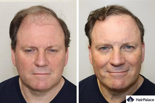 Derek before and after hair transplant