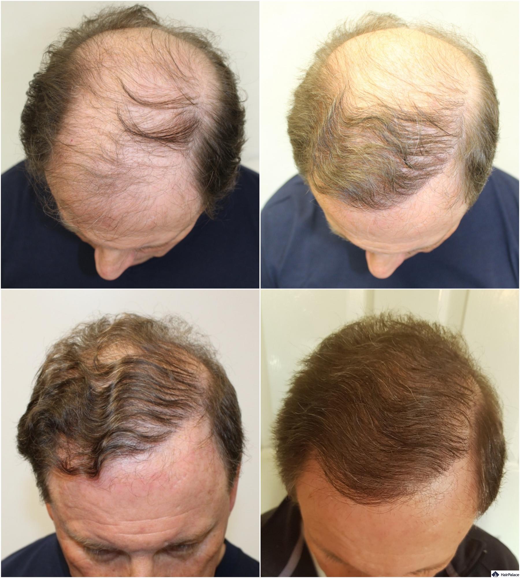 FUE hair restoration step by step