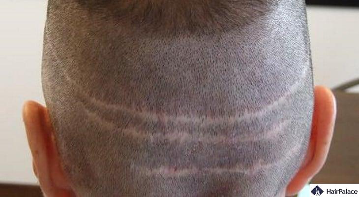 FUT hair transplant leaves a visible scar