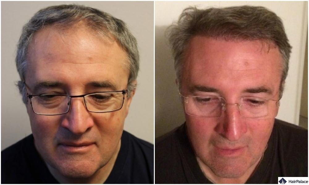 successful hair transplant result in Newbury