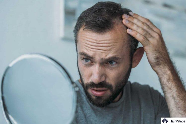 receding hairline symptom