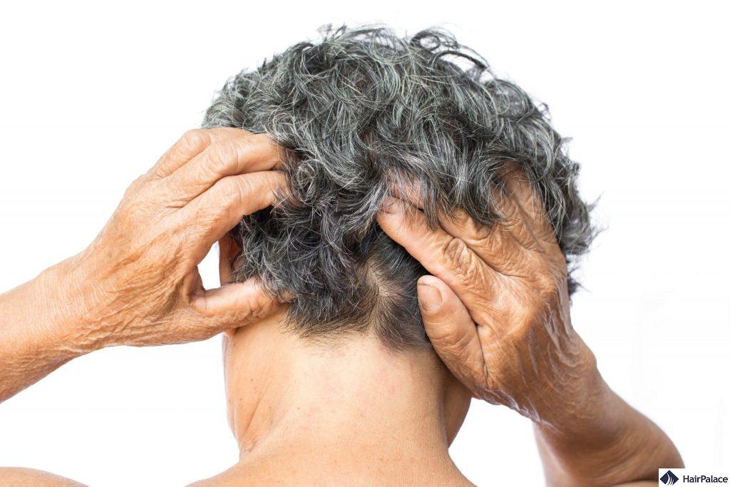 irritating scalp psoriasis