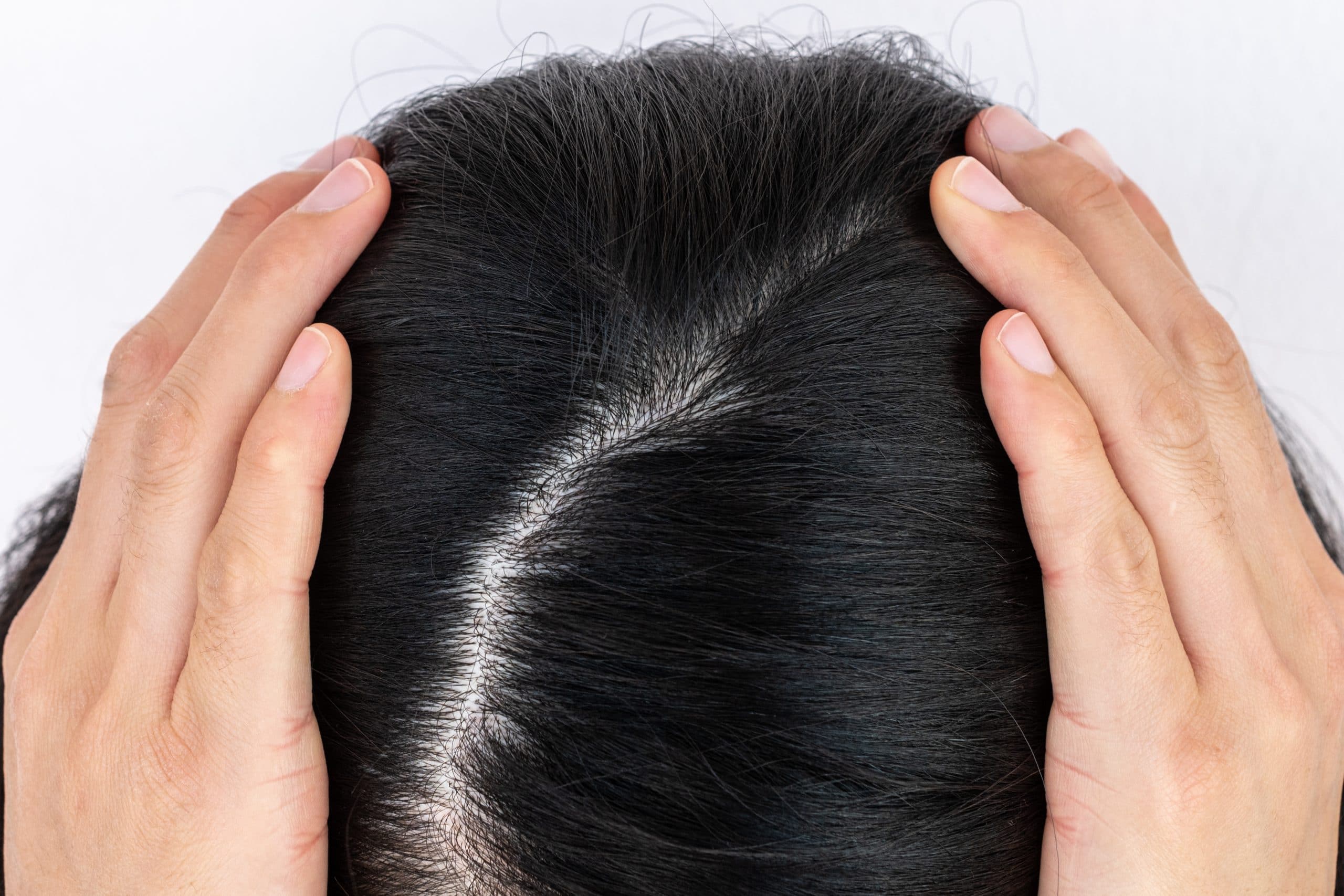 genetic hair loss widening hair