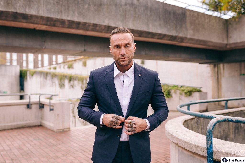 The Calum Best hair transplant journey