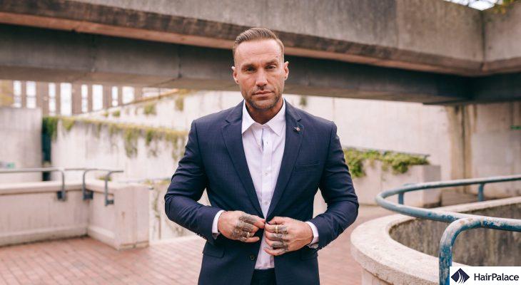 The Calum Best hair transplant journey