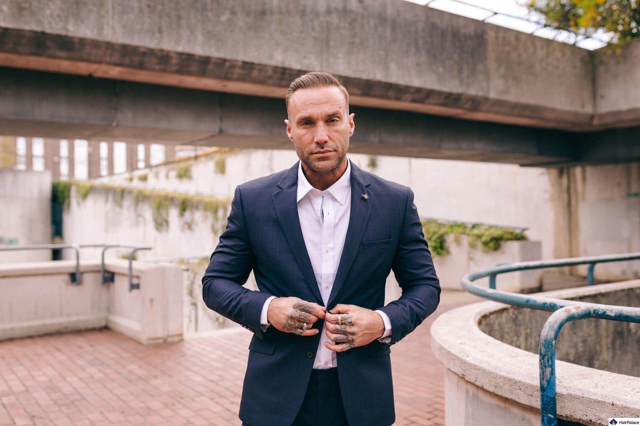 Calum Best Hair Transplant | Decisions, Surgeries & Costs Calum Best Hair Transplant | Decisions, Surgeries & Costs