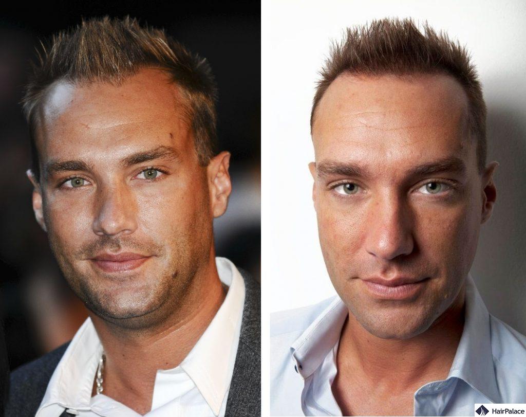 Calum Best before and after his first hair treatment
