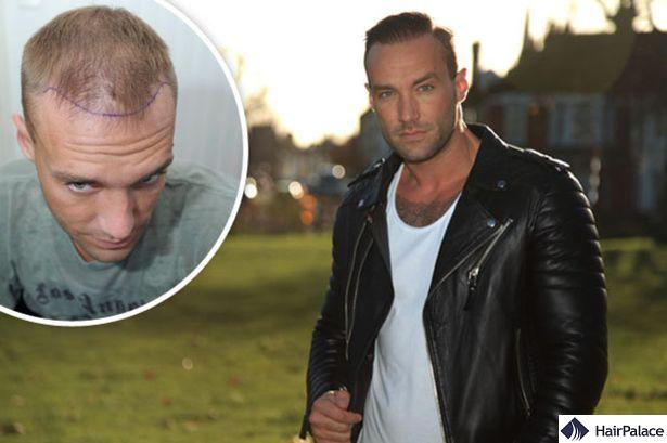 Calum Best after his third procedure