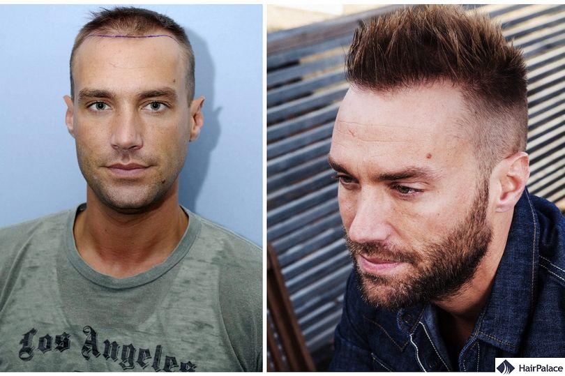 Calum Best before and after his second hair transplant
