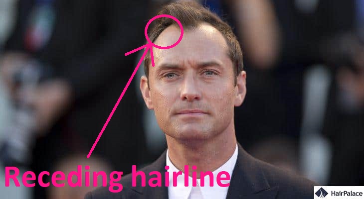 Jude Law hair transplant rumours