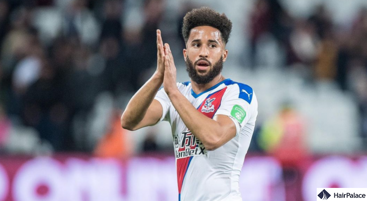 Andros Townsend possible hair restoration