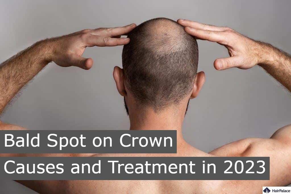Bald spot on crown causes and treatment in 2023