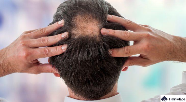 Plaske Mudret leder Bald Spot on Crown | How to Spot & Stop It [2023]