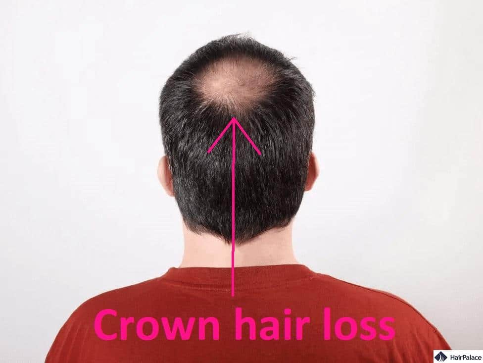 Hair loss at shop 17 male