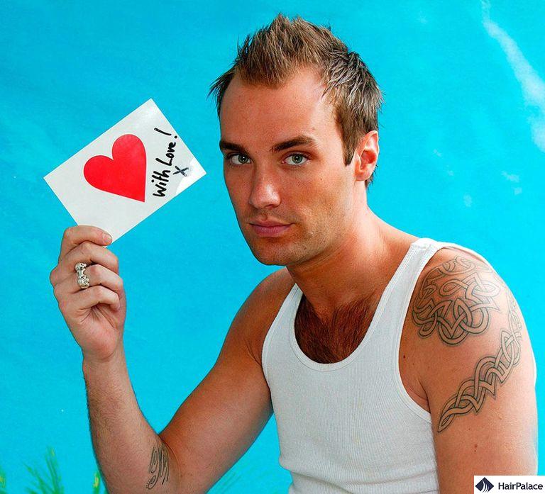 Calum Best with M-shaped hairline