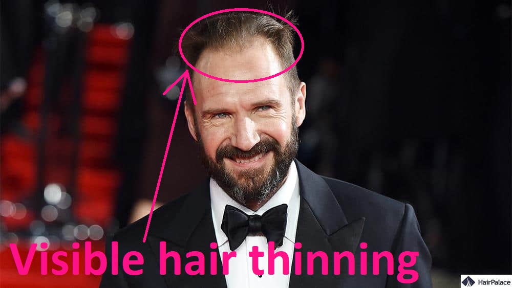 ralph fiennes thinning hair