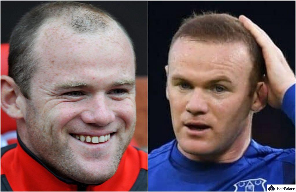 wayne rooney hair transplant result