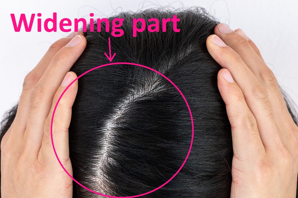 genetic hair loss widening hair