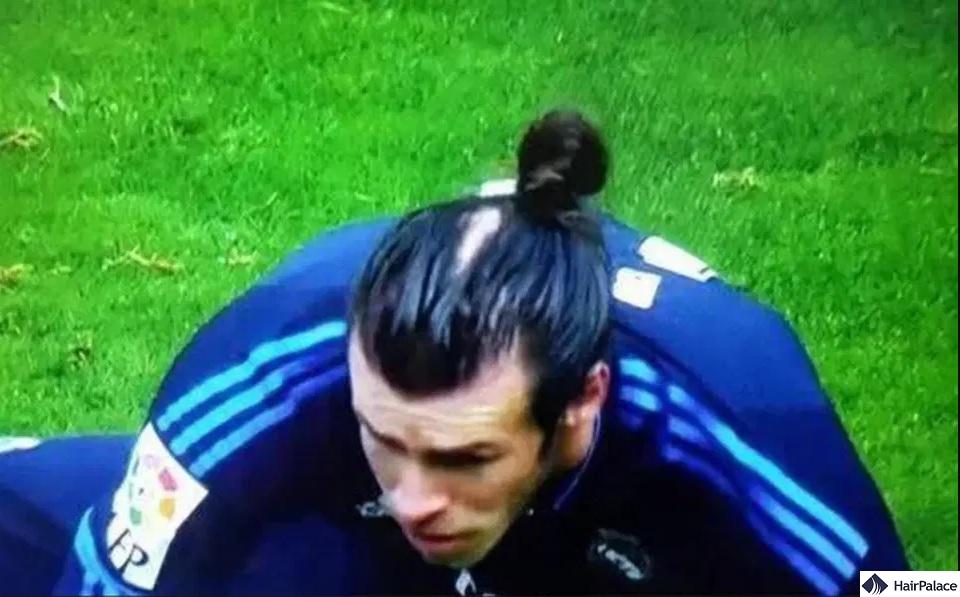 gareth bale bald spot