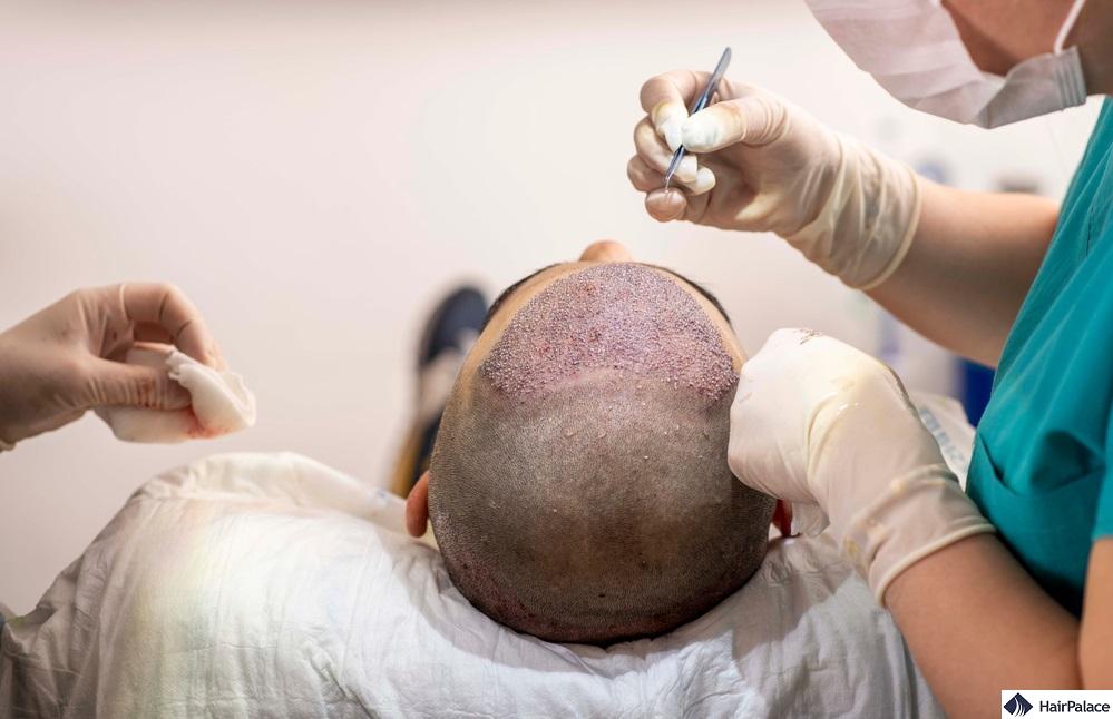 advantages of hair transplantation