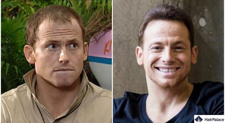 joe swash hair transplant result