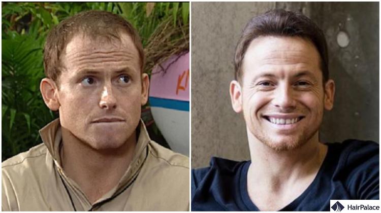 joe swash hair transplant result