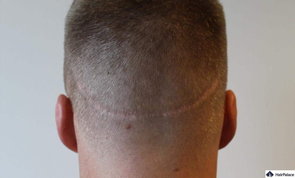 Hair Transplant Scar | Can It Be Removed or Will It Be Permanent?