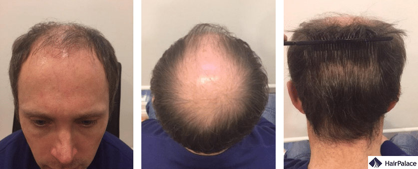 Tom's Two Hair Transplant Sessions - HairPalace