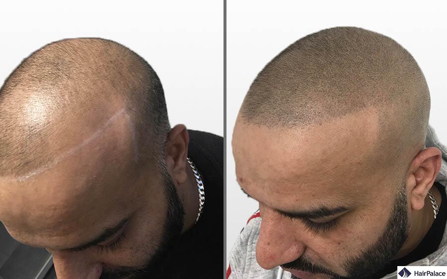 Scalp Micropigmentation Benefits