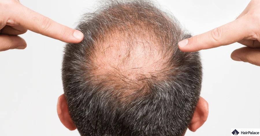 dht hair loss