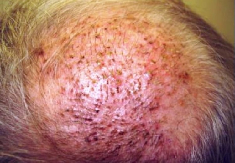 hair transplant infection redness