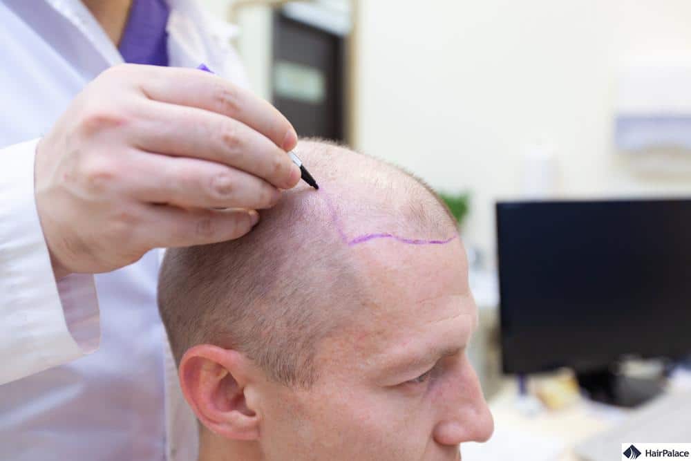 a private hair transplant offers several benefits over a hair transplant on NHS