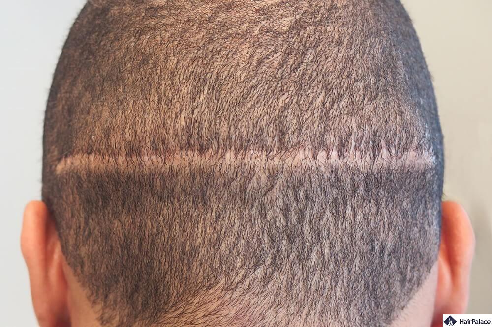 hair transplant fut scar