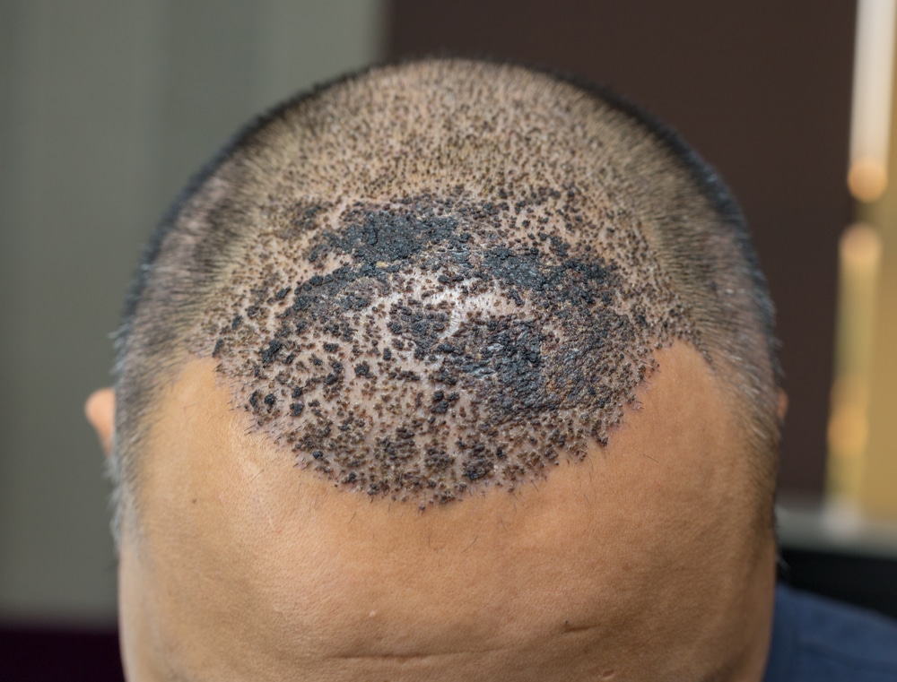 worst hair transplant infection symptoms