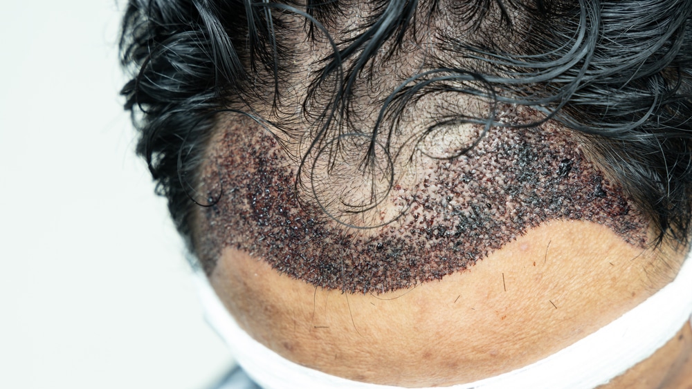 Infected hair transplant