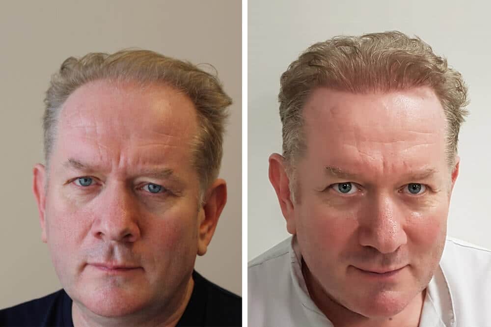 regis Hair Palace FUE Hair Transplant in Budapest