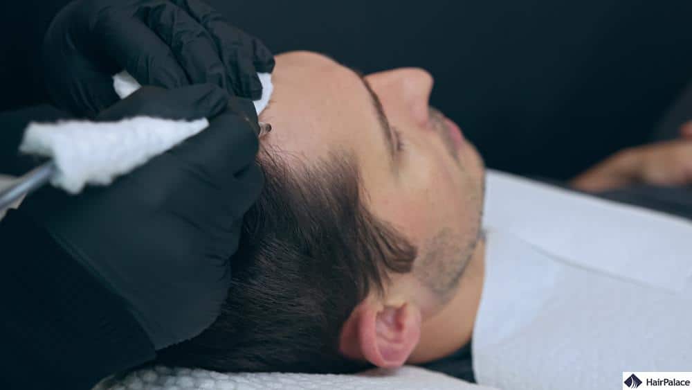 how long will scalp micropigmentation last