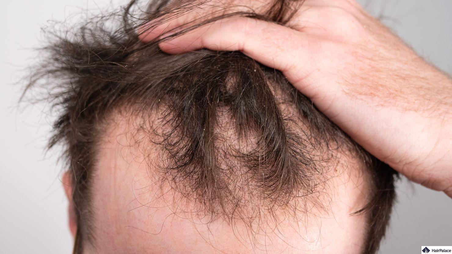 early signs of baldness