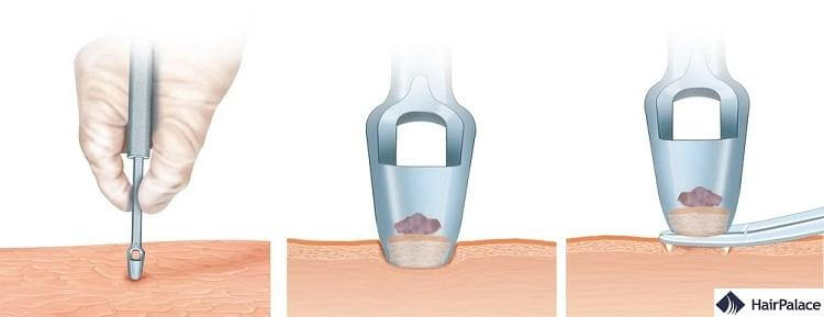 punch biopsies may lead to nerve damage