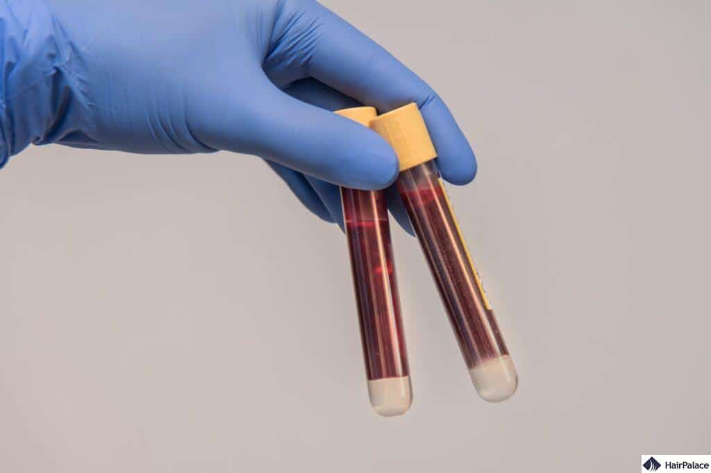 platelet-rich plasma