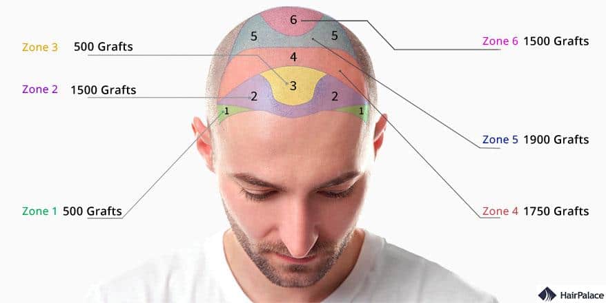 grafts per hair transplants