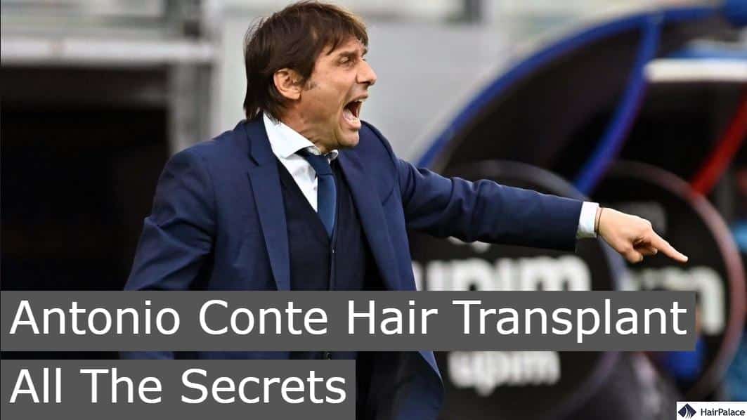 Antonio Conte hair transplant