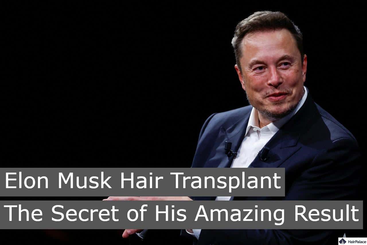 Elon Mush hair transplant the secret of his amazing result