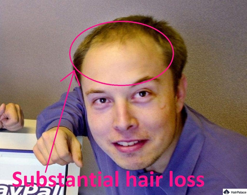 Young Elon Musk suffering from hair loss