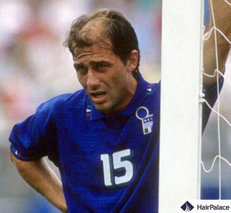 antonio conte hair loss at young age