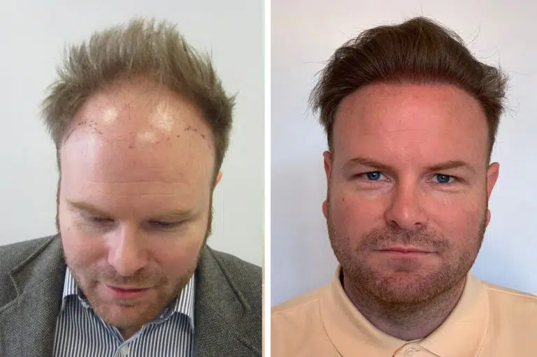 Hair Transplant Before and After | 30 Amazing Photos 2022