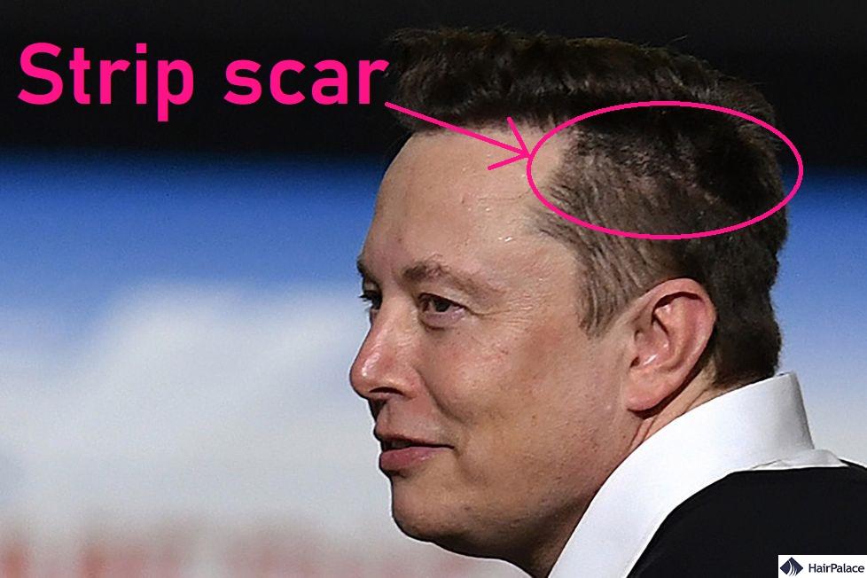 elon musk strip scar