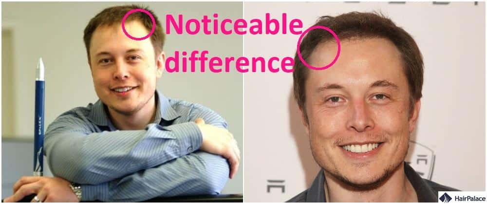 The first Elon Musk hair transplant acheived stunning results