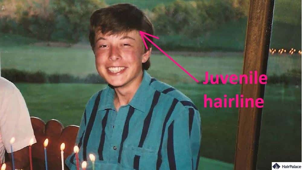 Elon mush showed no signs of hair loss as a teen
