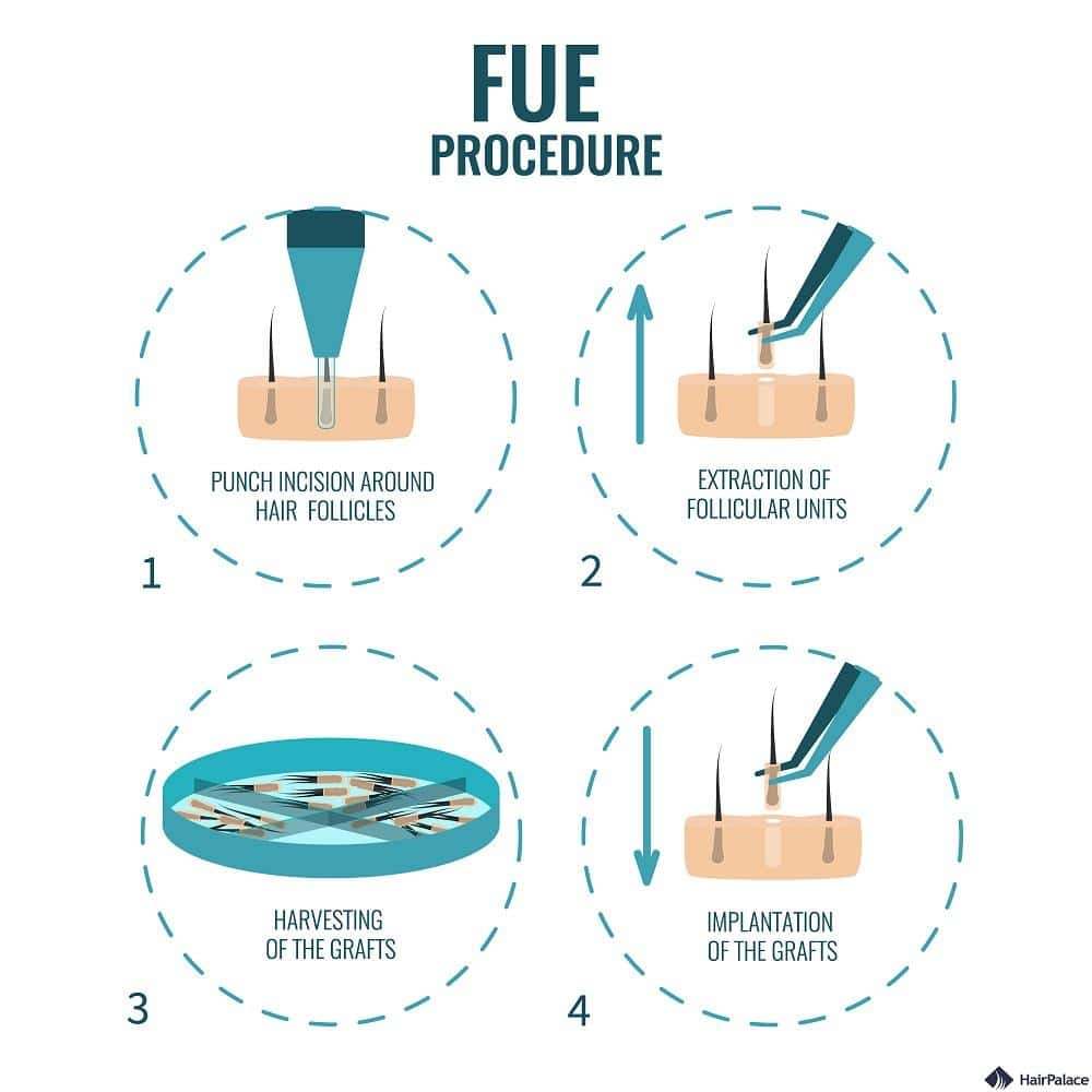 steps of the fue hair transplant process